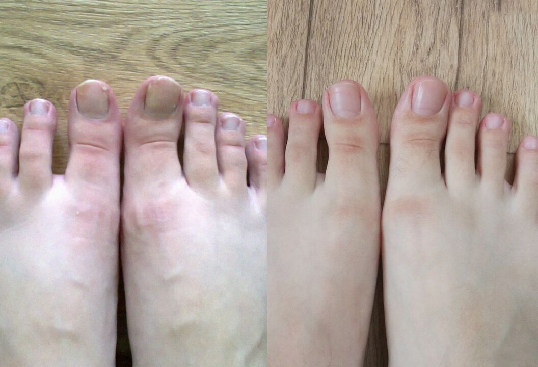 Antes y después del tratamiento, la crema prometida del hongo