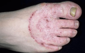 Las razones de la aparición del hongo en las piernas