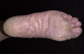 Signos y síntomas de hongos en las piernas