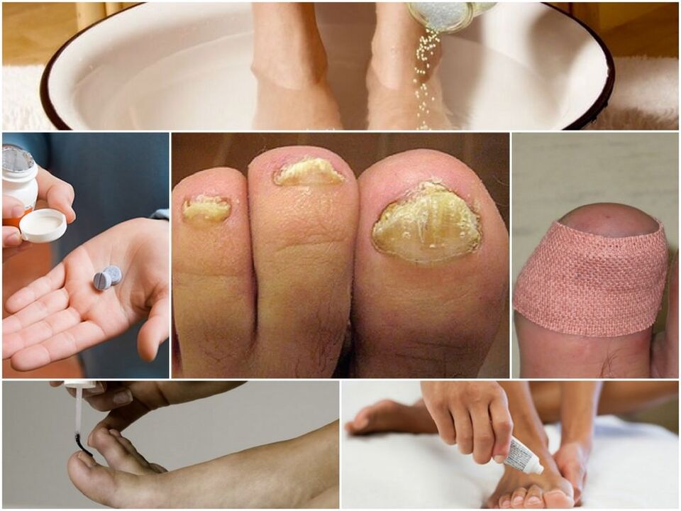 Tratamiento del hongo de las uñas