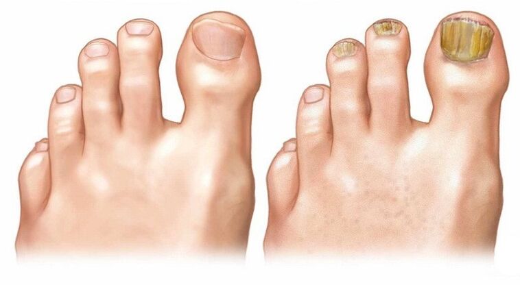 Uñas de uñas sanas e infectadas
