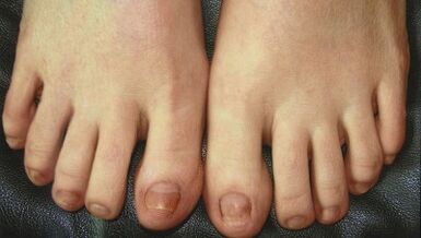 Etapas de desarrollo del hongo de uñas