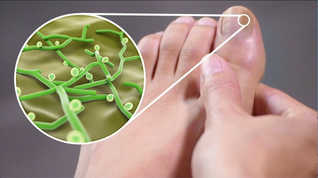 patógenos de hongos en las uñas de los pies