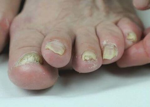 tratamiento de hongos en las uñas con medicamentos