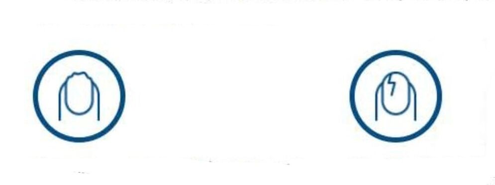 deformación de las uñas debido a una infección por hongos