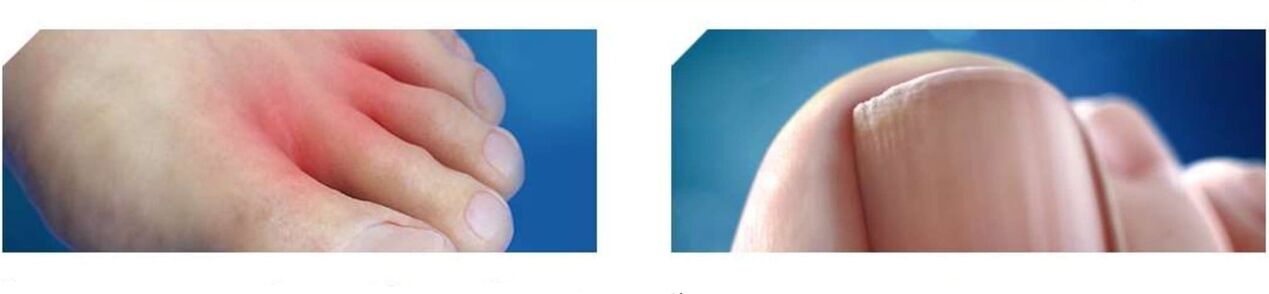 etapa inicial de hongos en los pies