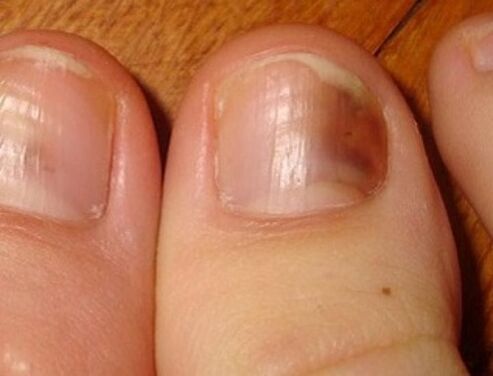 síntomas de hongos en las uñas de los pies