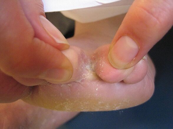 hongos en los dedos de los pies