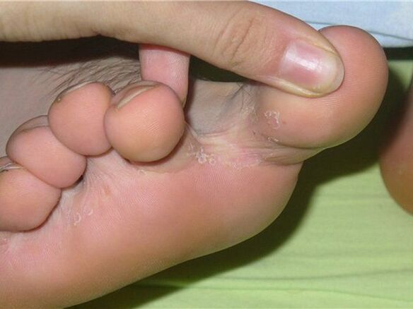 síntomas de hongos en los dedos de los pies